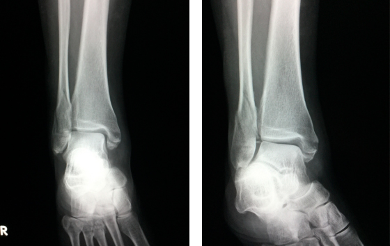 足関節内外果骨折の治療