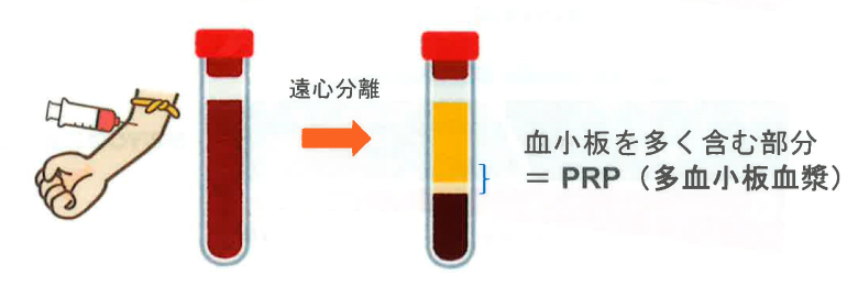 PRPとは多血小板血漿のこと、患者さん自身の血液から抽出